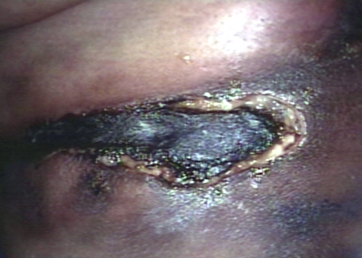 Skin: ulcer, necrotic; lupus anticoagulant in thigh. Image courtesy of Professor Peter Anderson DVM PhD and published with permission © PEIR, University of Alabama at Birmingham, Department of Pathology.[26]