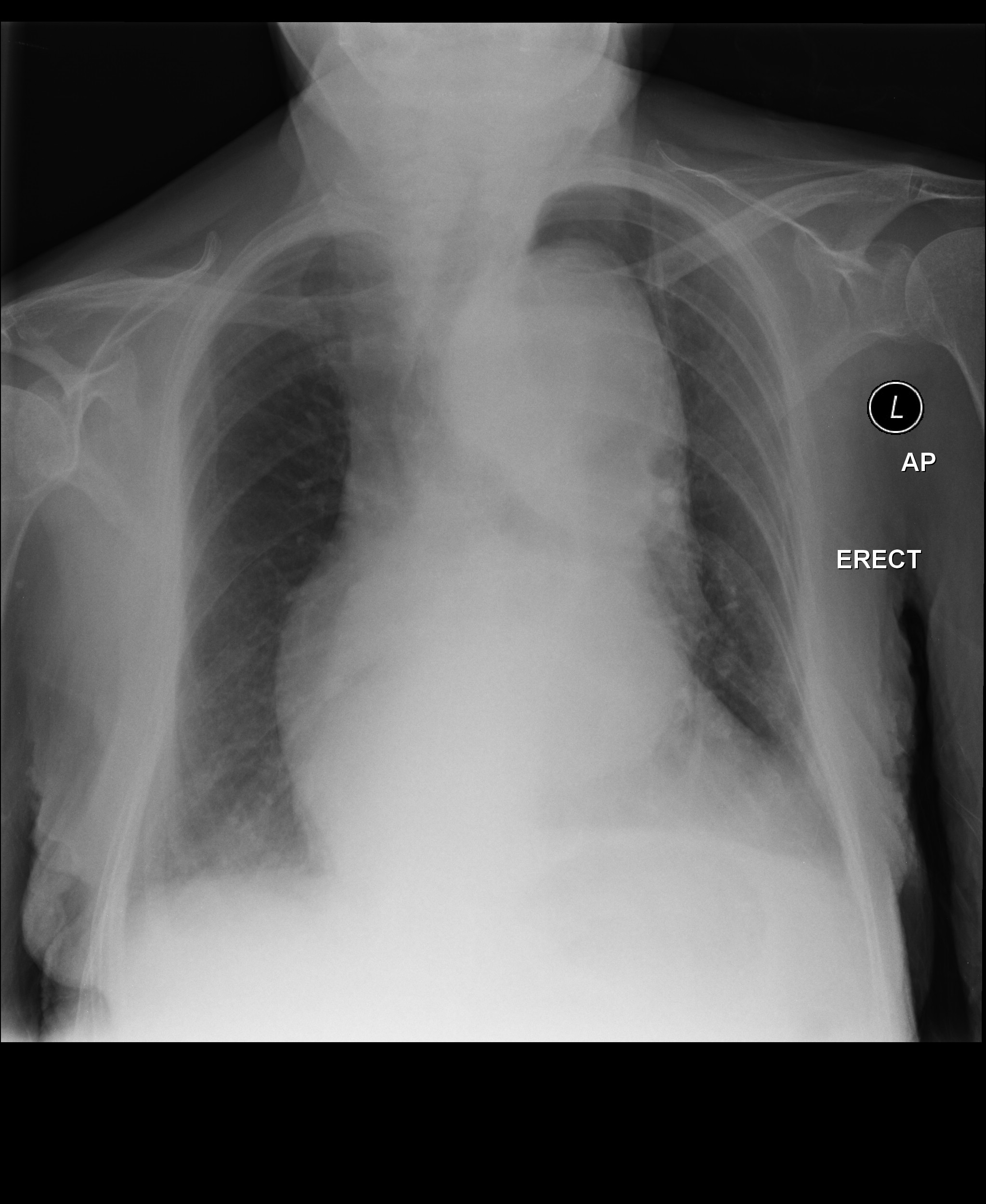 File:Thoracic-aortic-aneurysm-16.jpg