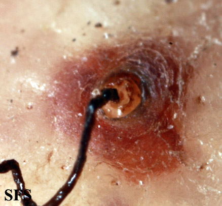 Tungiasis. Adapted from Dermatology Atlas.[1]
