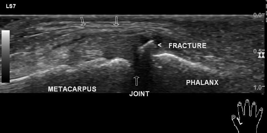 There is an avulsion fracture from proximal phalanx base at site of ulnar collateral ligament attachment. Ligament is odematous - hypoechoic. However, ligament and bony flake are deep to appneuosis. There is no pseudomass formation abutting metacarpal head.