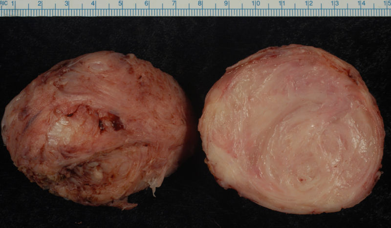 Leiomyoma enucleated from a uterus. External surface on left; cut surface on right