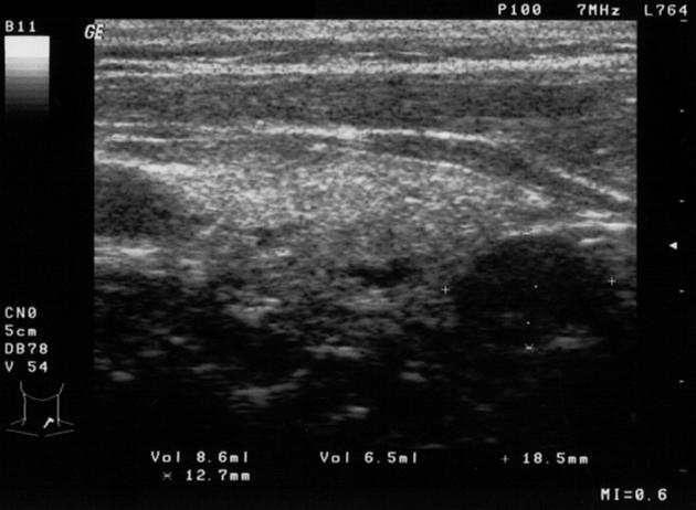 File:Parathyroid adenoma ultrasound.jpg