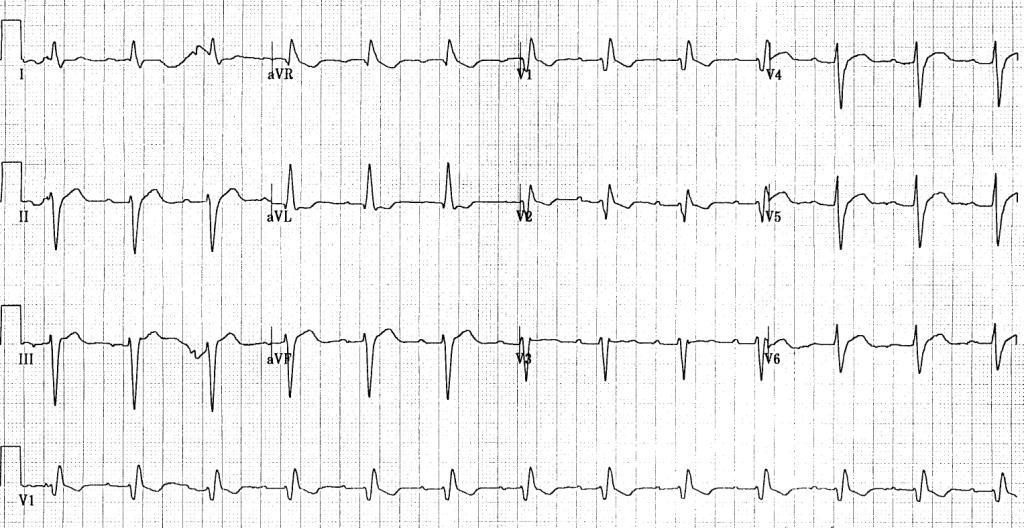 12 lead EKG: Trifascicular block