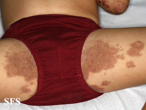 Acrodermatitis enteropathica. 'Adapted from Dermatology Atlas.[1]