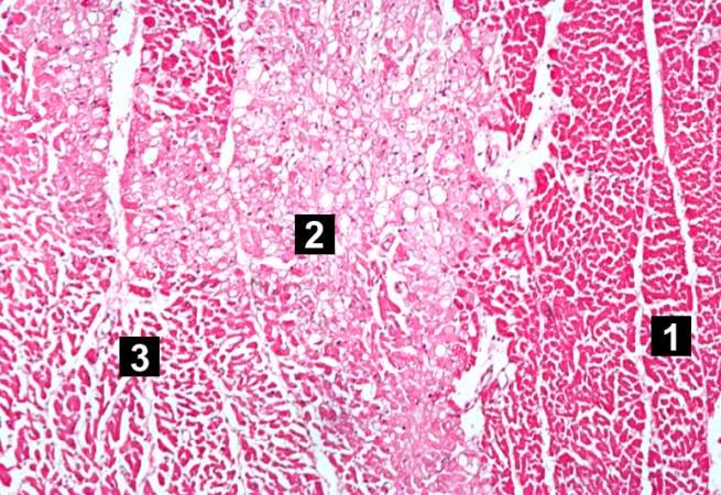 This high-power photomicrograph shows the area of infarction on the right (1). There is an area of vacuolated myocytes (2) adjacent to the infarcted myocytes and then normal cardiac muscle to the left (3).