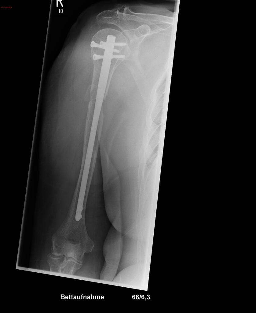 File:Humerus-fracture-before-and-after-osteosynthesis.jpg