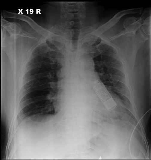 File:Implantable-cardiac-monitor-1.jpg
