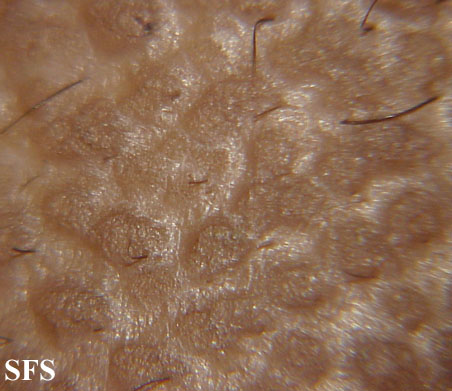 File:Lichen amyloidosus12.jpg
