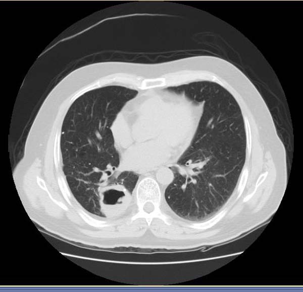 CT: Wegener's granulomatosis