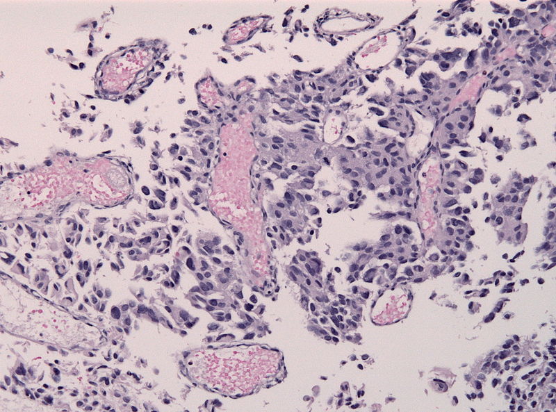 File:800px-PTPR papillary tumor pinealis HE microscopic image 2.jpg