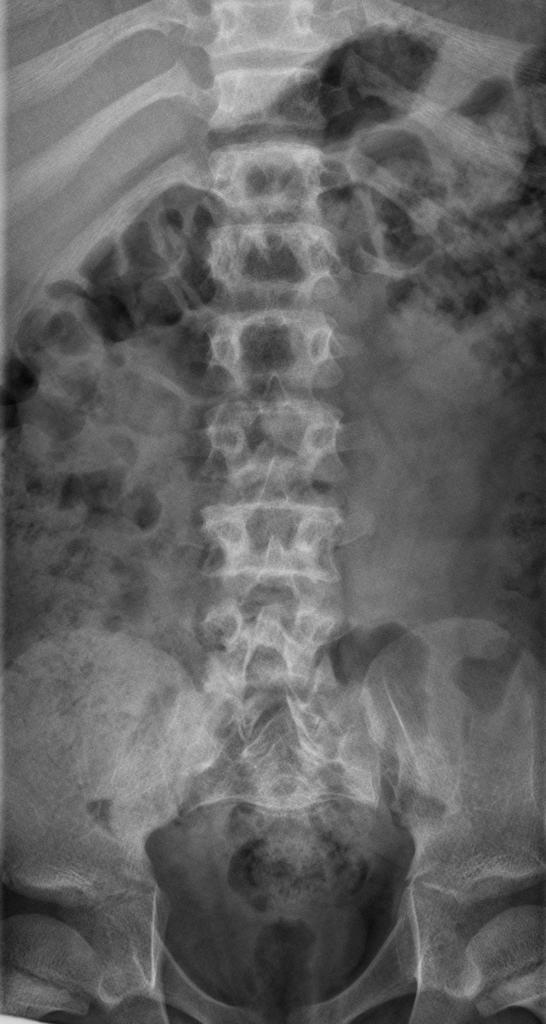 File:Achondroplasia (9).jpg