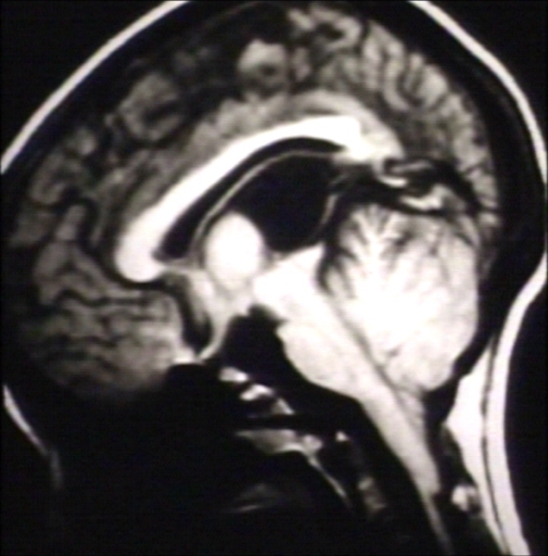 BRAIN: ARNOLD CHIARI II (MRI)