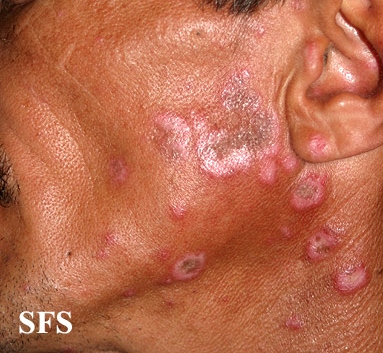 Discoid lupus erythematosus. Adapted from Dermatology Atlas.[26]