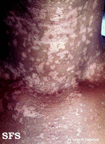 Epidermodysplasia verruciformis. Adapted from Dermatology Atlas.[1]