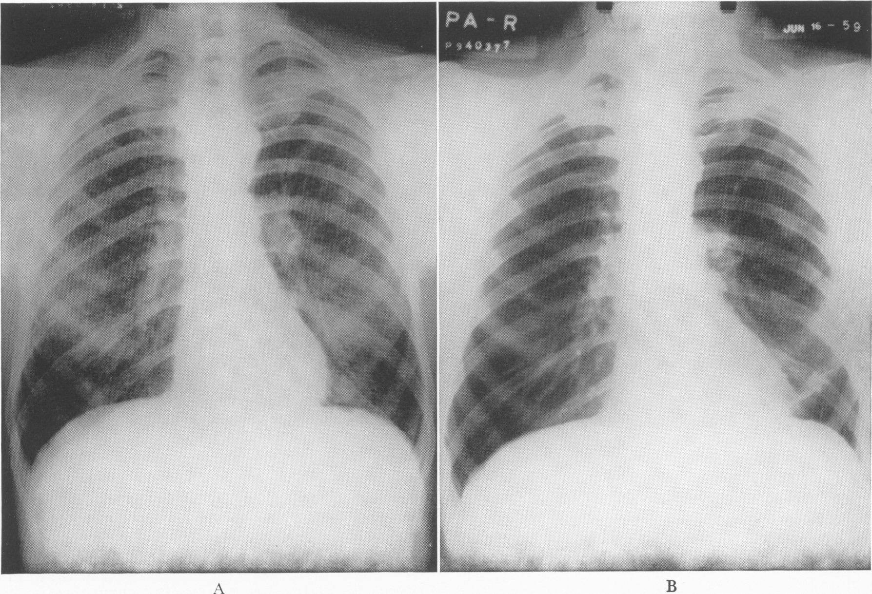 File:Hypersensitivity pneumonitis.jpg