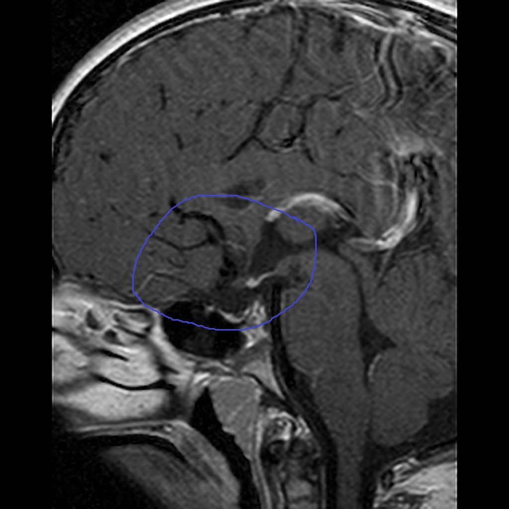 File:Pituitary-stalk-interruption-syndrome-1.jpg