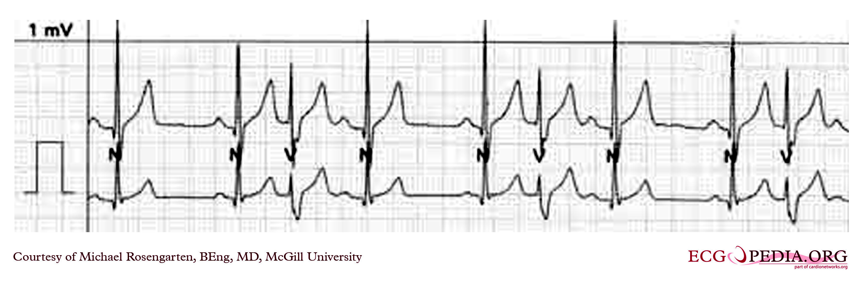 Premature Ventricular Contractions with trigeminal rhythm.jpg