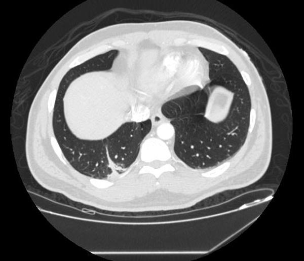 CT: Pulmonary Embolism and Infarction