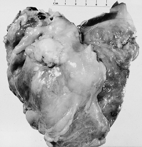 MALIGNANT MESOTHELIOMA: PERICARDIUM Note the gross tumor studding the epicardial surface.