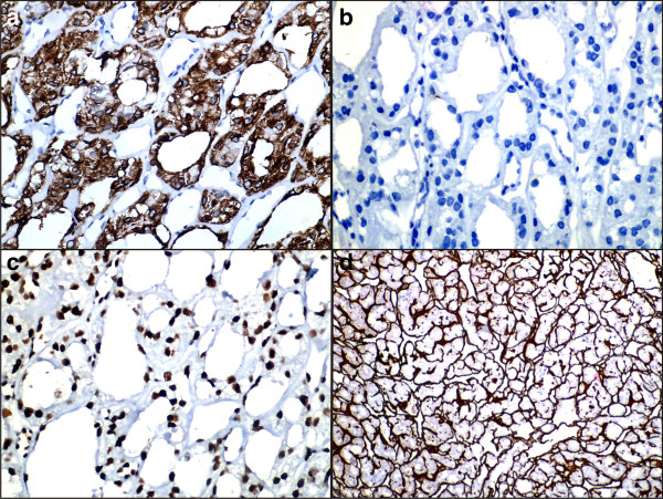 (a) Cytoplasmic and membrane positivity for cytokeratin 7 immunostain (400×); (b)negativity for cytokeratin 20 immunostain (400×); (c) nuclear positivity for retinoblastoma immunostain (400×); and (d) extracellular positivity for collagen type IV immunostain (400×).[1]