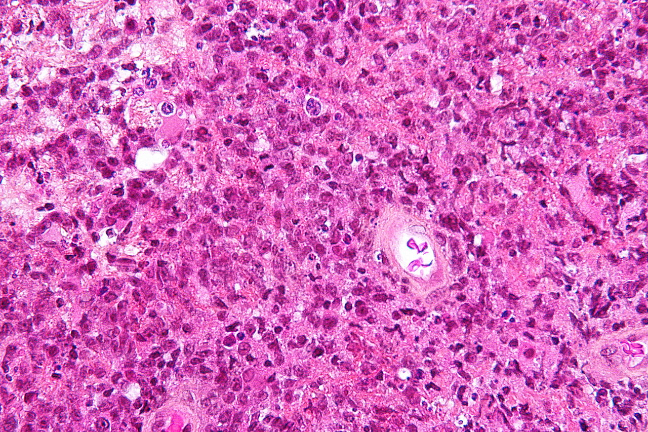 File:Microscopic pathological image of primary central nervous system lymphoma image 1.jpg