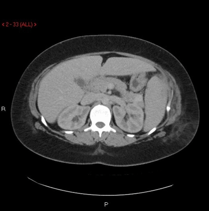 File:Splenic abscess CT images.gif
