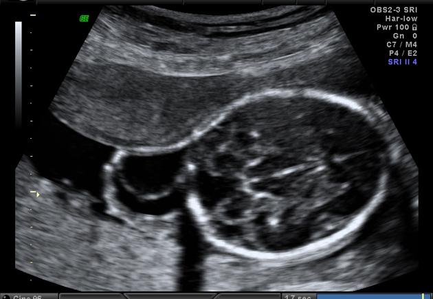 File:Ultrasound Turner Syndrome Cystic Hygroma.jpg