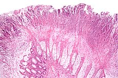 Micrograph of a colonic pseudomembrane, a finding that may be associated with ischemic colitis on H&E stain