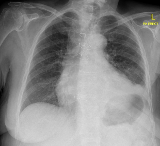 File:Left hemidiaphragm paralysis after cardiac surgery.jpeg