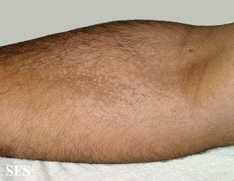 Pityriasis versicolor. Adapted from Dermatology Atlas.[1]