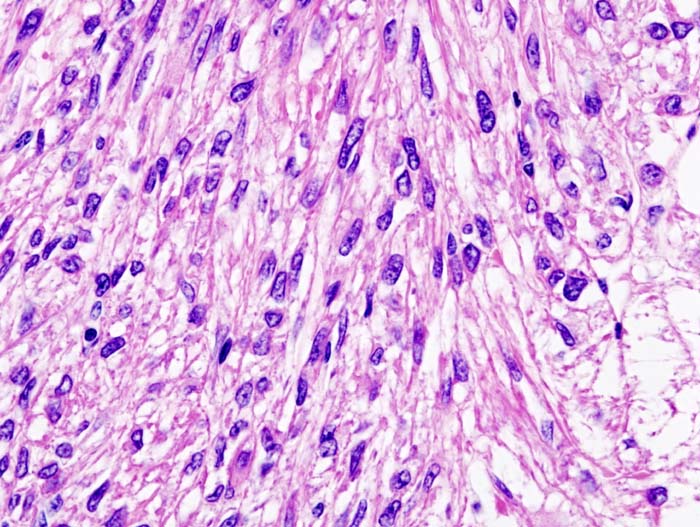 Histopathologic slide of renal angiomyolipoma. Nephrectomy specimen. H & E stain.[3]