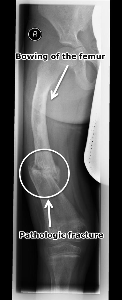 File:Rickets-with-pathological-fracture.png
