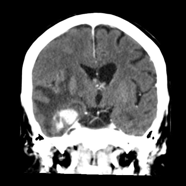 Contrast CT scan of a 60 year old hispanic female with known history of metastatic breast cancer demonstrates two round lesions with ring-shaped enhancement in the right temporal region with perilesional edema.[11]