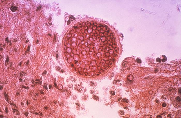 PAS-stained photomicrograph of an unknown tissue specimen revealed the presence of three Coccidioides immitis spherules. From Public Health Image Library (PHIL). [5]