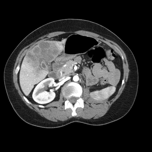 CT: Gallbladder adenocarcinoma