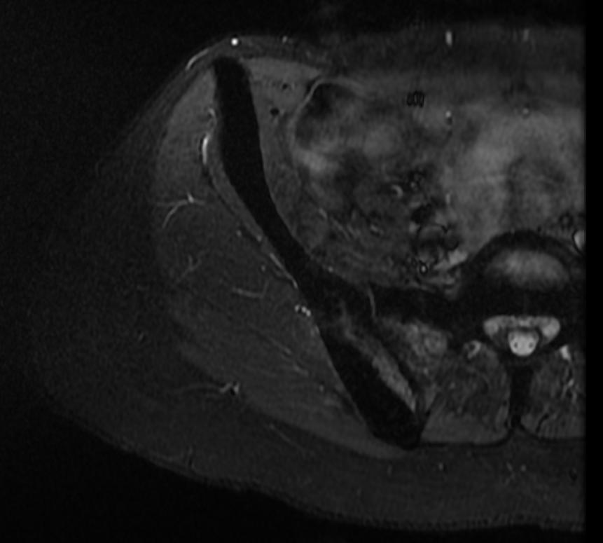 File:Osteopetrosis MRI 205.jpg