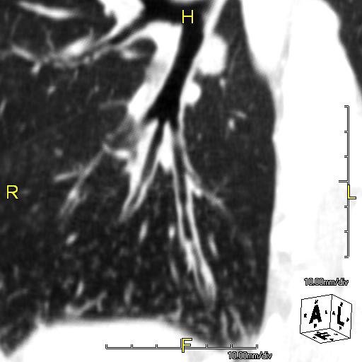 Oblique sagittal CT image showing lower lobe cylinidrical bronchiectasis in the same patient