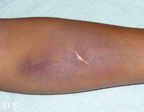 File:Painful bruising syndrome02.jpg