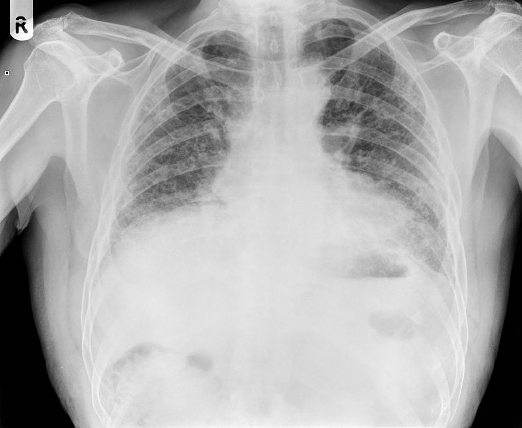 File:Pulmonary fibrosis.gif