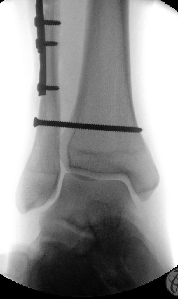 File:Unstable-ankle-injury-2.jpg