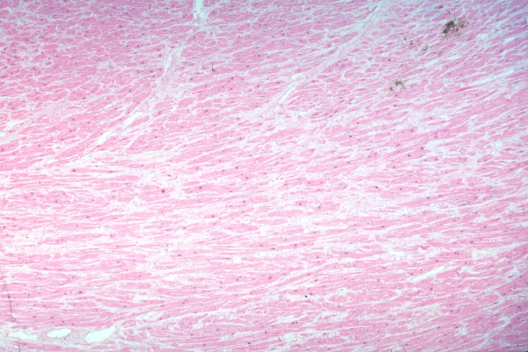 Micro med mag H&E myofiber hypertrophy some atrophy interstitial fibrosis with many fibroblastic cells