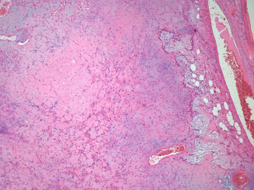 Histopathology specimen of a chondromyxoid fibroma showing stellate cells in myxohyaline stroma