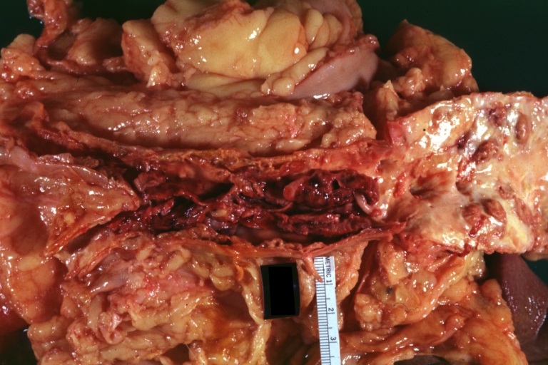 Atherosclerosis: Aorta: Gross, thrombotic occlusion extending from just below renal arteries into iliac artery