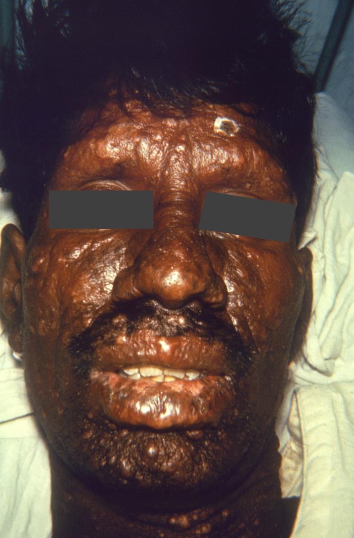 Nodular lepromatous or multibacillary leprosy. Presence of cutaneous nodules and missing eyebrows. Adapted from Public Health Image Library (PHIL), Centers for Disease Control and Prevention.[6]