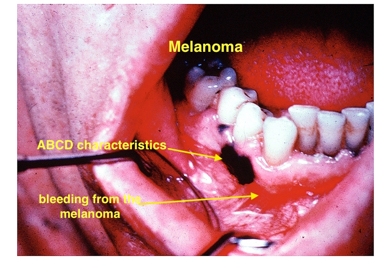 Oral melanoma