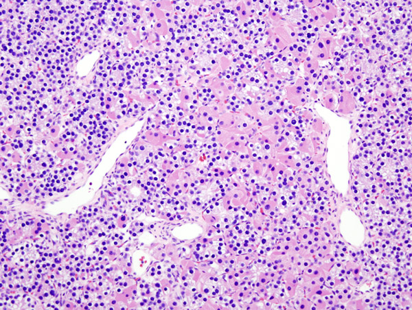 Histopatholgical image of parathyroid adenoma in a patient with primary hyperparathyroidism. Hematoxylin and eosin stain.
