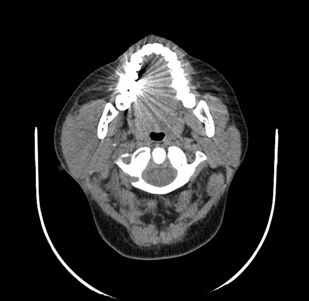 CT of the neck demonstrating an enlarged left parotid gland with inflammatory changes of the subcutaneous soft tissues consistent with parotitis.. From Radiopaedia Image Library. [3]