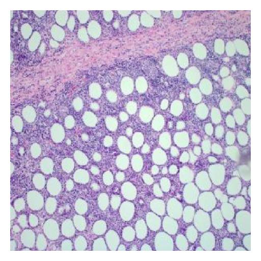 Biopsy of soft tissue : at 10x magnification shows lymphoid infiltrate with pattern resembling lobular and septal panniculitis[3]
