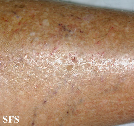 Xerotic eczema Adapted from Dermatology Atlas.<ref name="Dermatology Atlas">