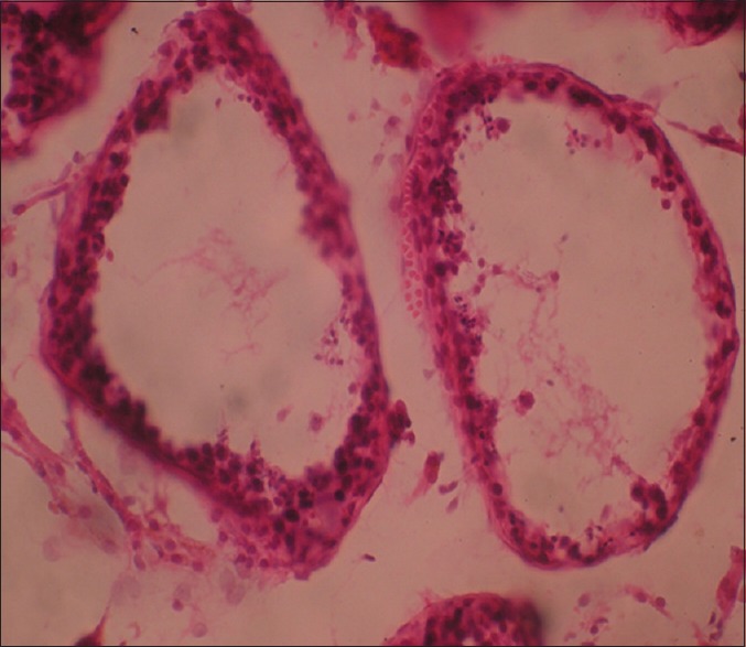 File:AIS - Microphotograph showing histopathology of testis.jpg